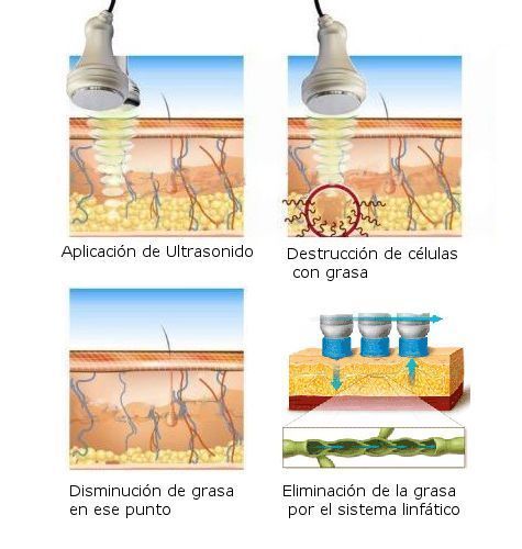 MÁQUINA REDUCTORA ULTRASÓNICA